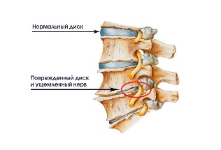 Симптоми шийного остеохондрозу